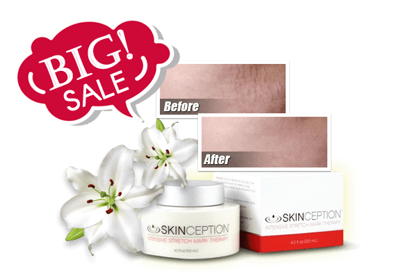 Stretch Mark Therapy